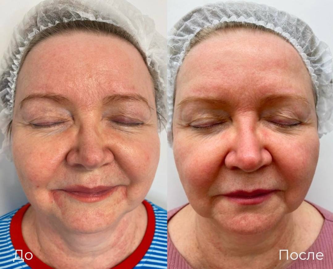 SMAS лифтинг лица Ultraformer фото 6