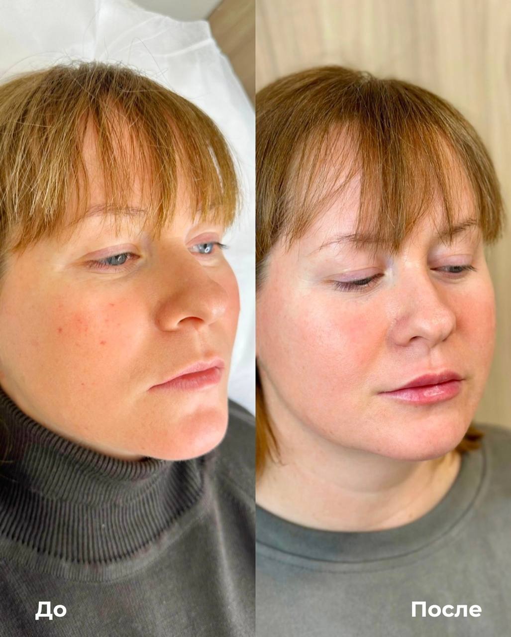 Увеличение и коррекция губ фото 6