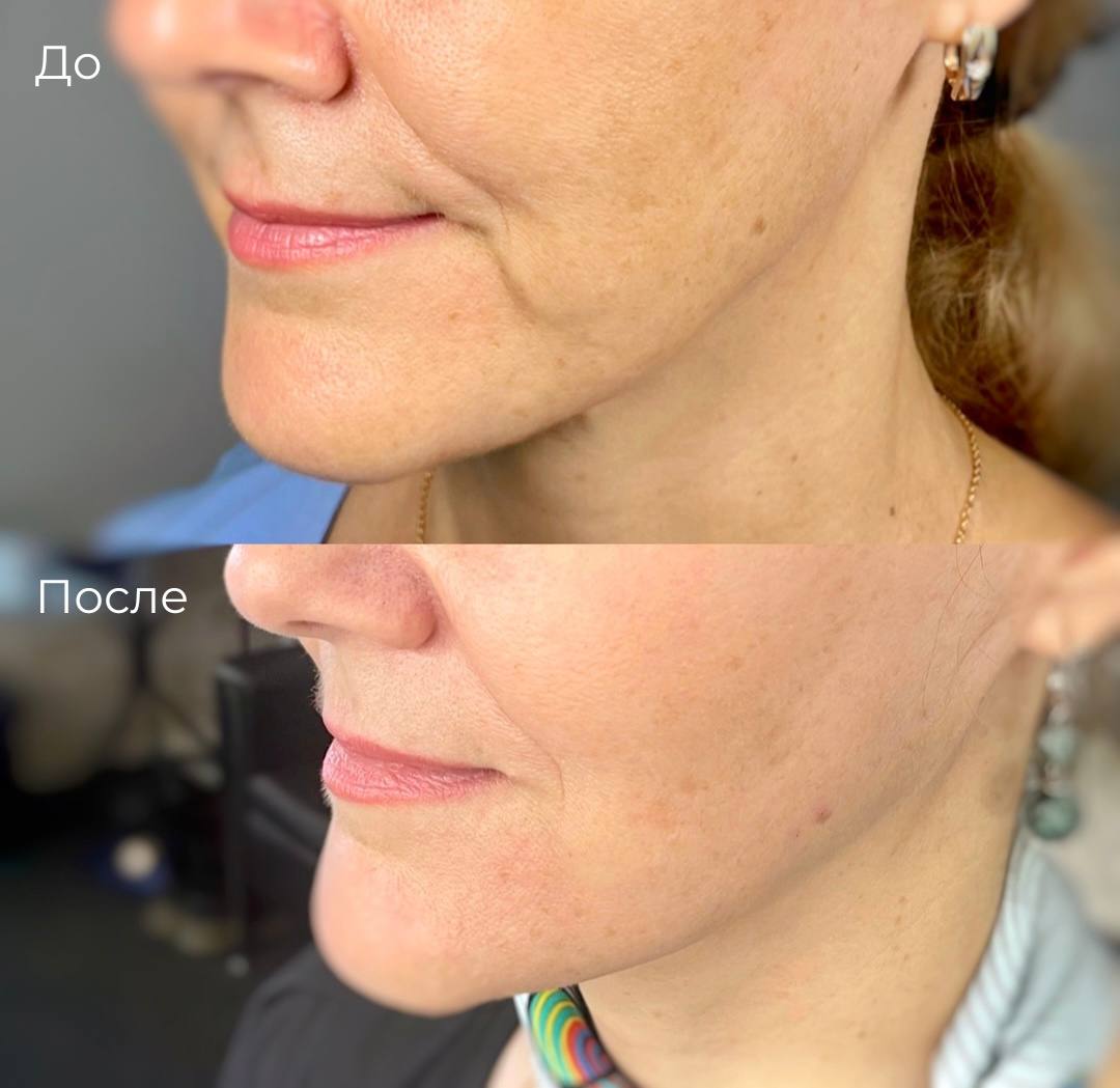 Лазерная шлифовка СО2 фото 5