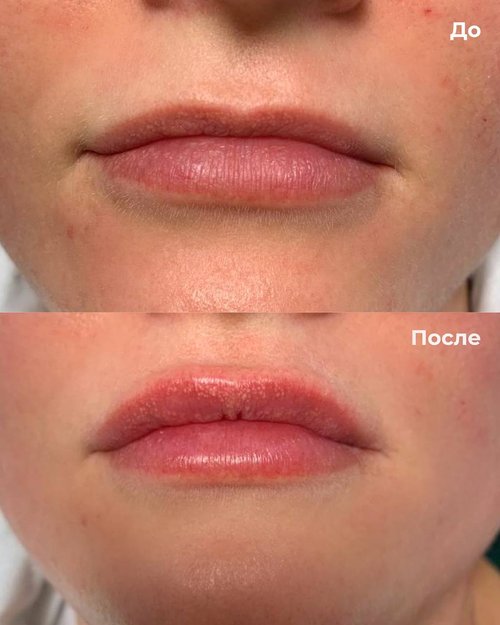 Увеличение и коррекция губ фото 10