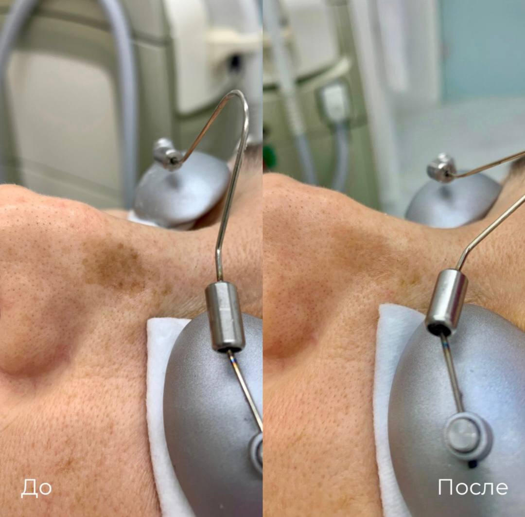 Фототерапия от пигментных пятен фото 6