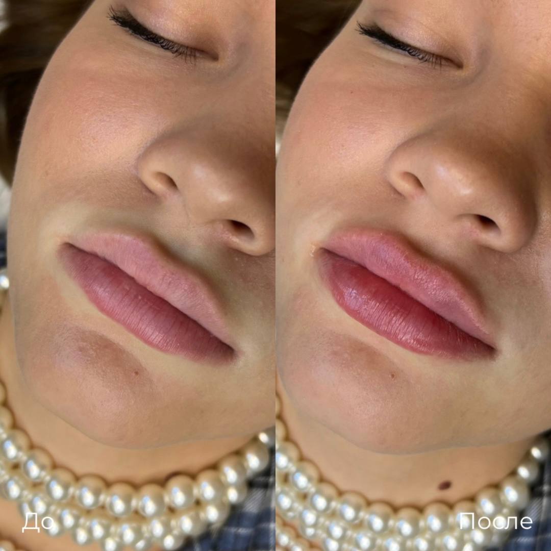 Увеличение и коррекция губ фото 20