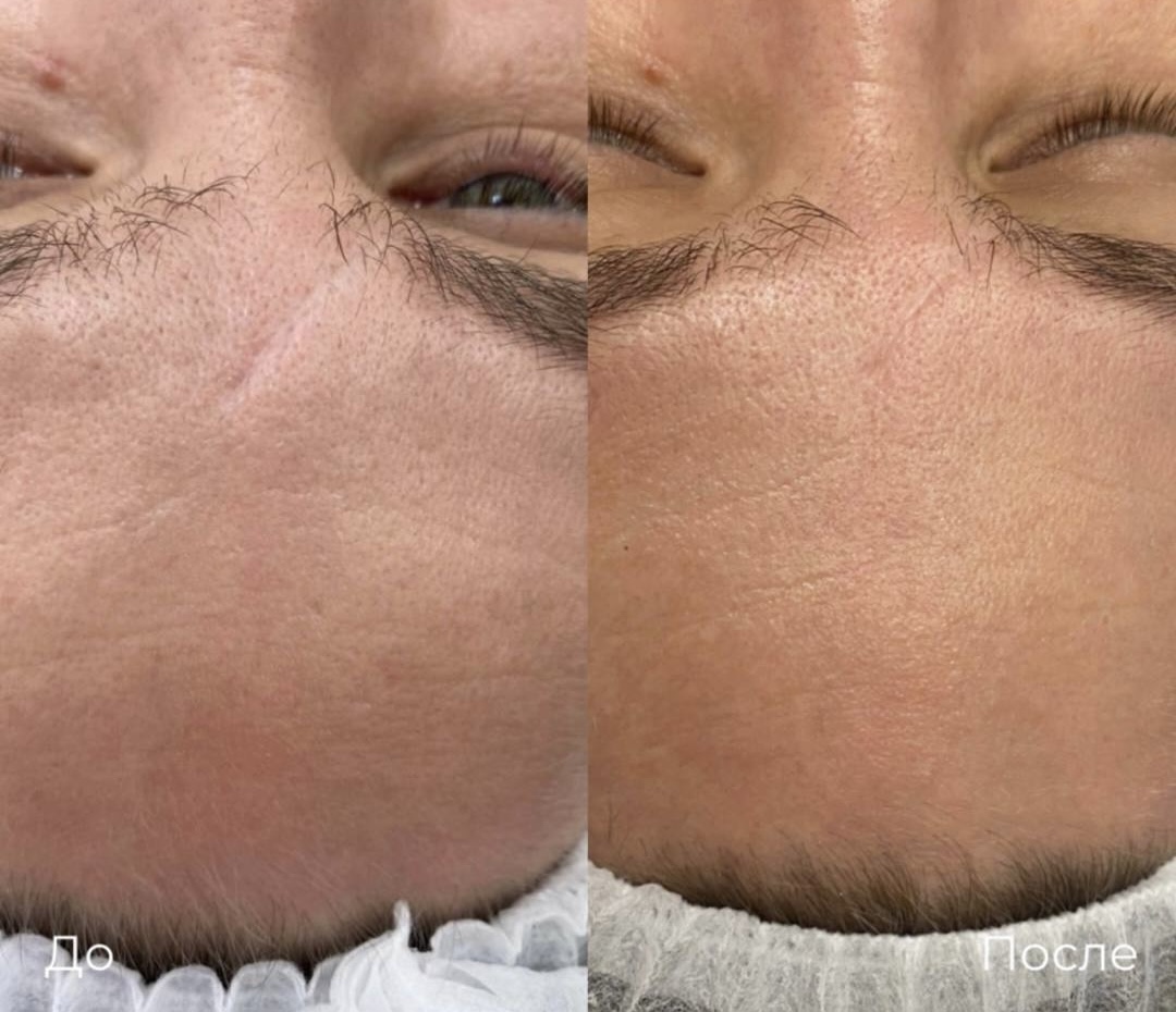 Субцизия фото 1