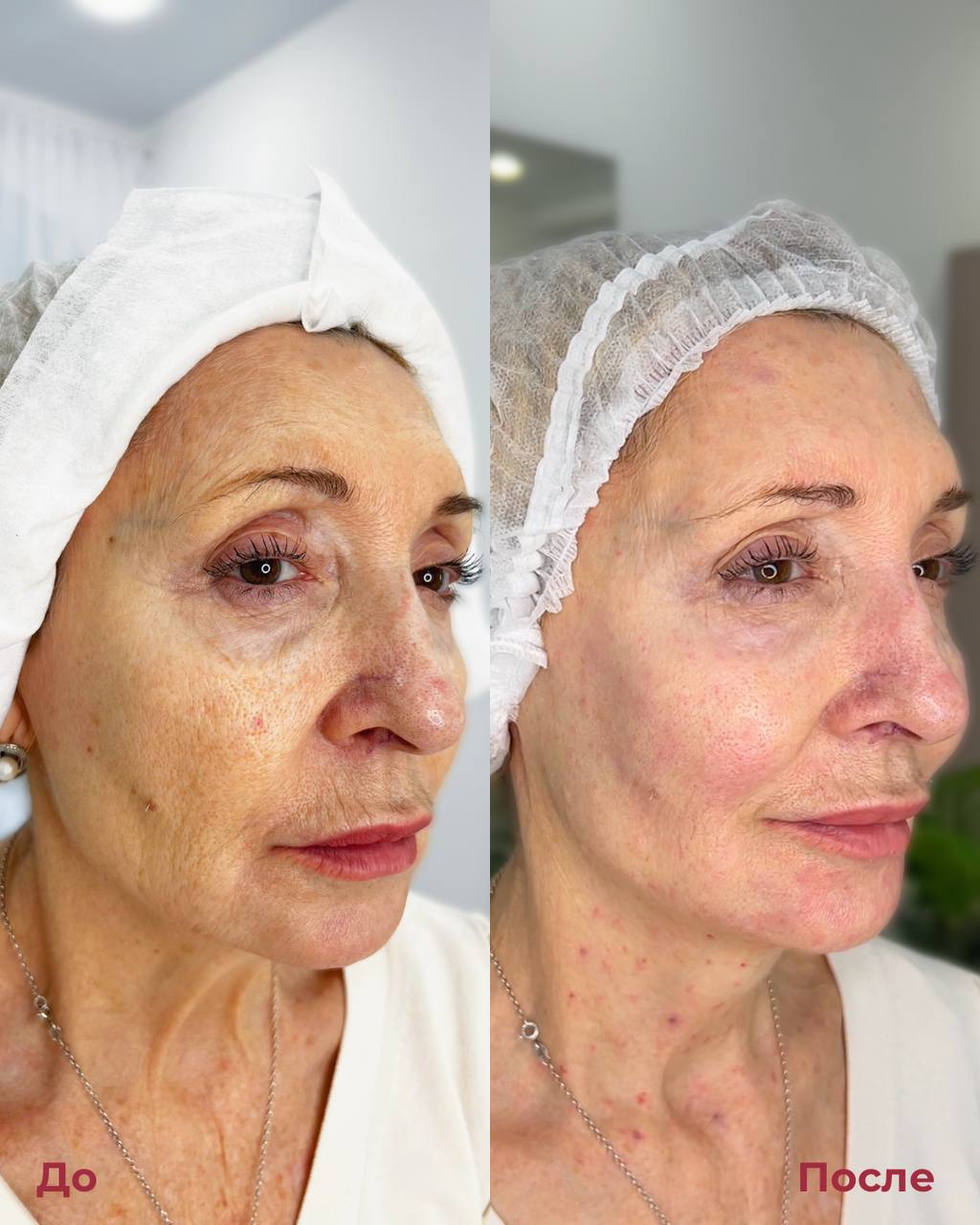 Биоревитализация фото 7