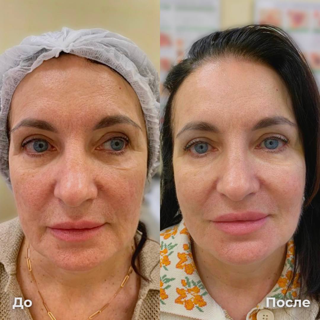 SMAS лифтинг лица Ultraformer фото 5