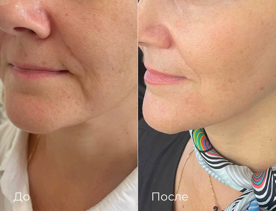 Лазерная шлифовка СО2 фото 7