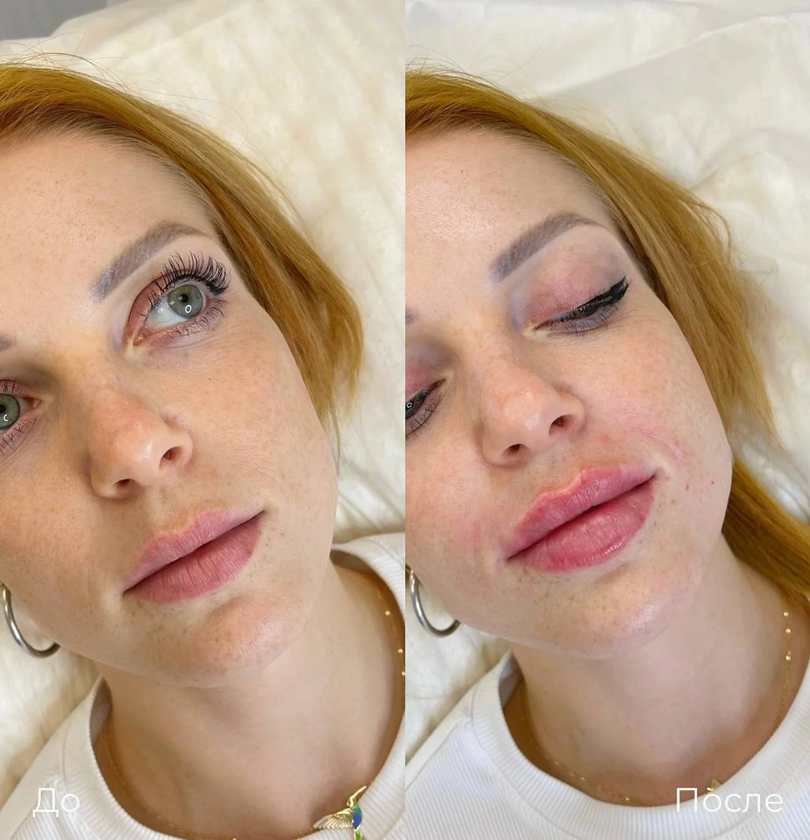 Увеличение и коррекция губ: фотография 37.