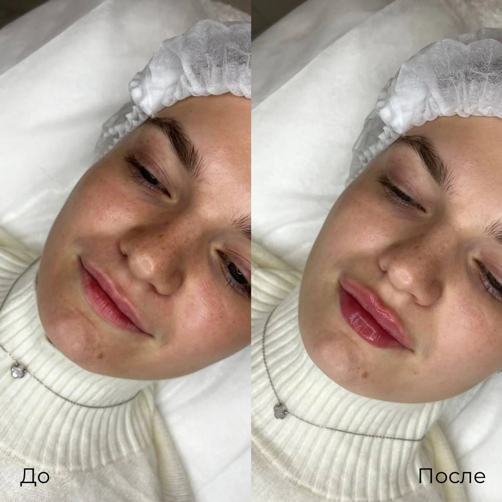Увеличение и коррекция губ: фотография 17.