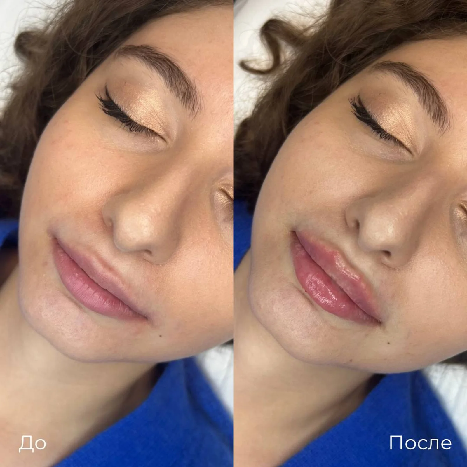 Увеличение и коррекция губ: фотография 16.