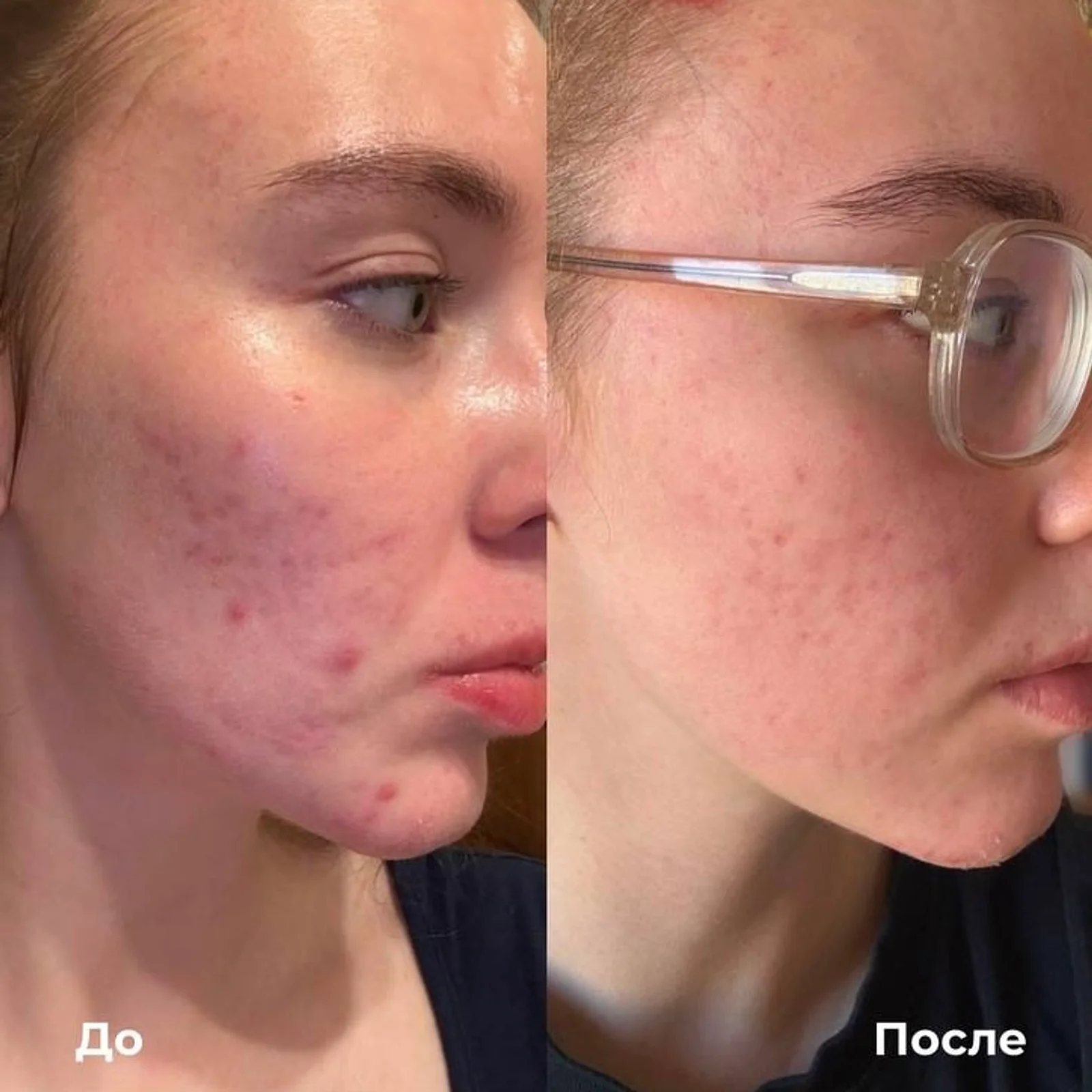 Лазерное лечение акне. Щека в полупрофиле: слева «До» с группой красных и тёмных точек, справа «После», где они менее заметны. Справа надеты очки.