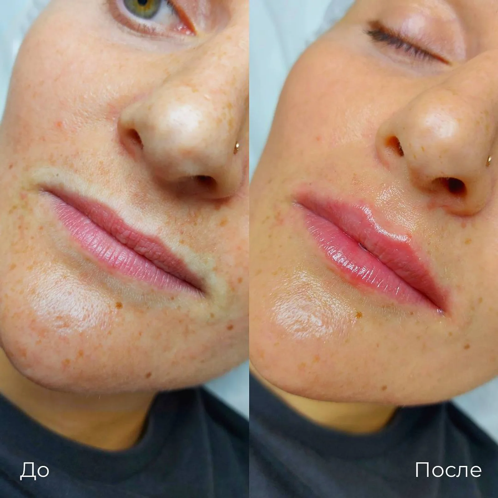 Увеличение и коррекция губ: фотография 31.