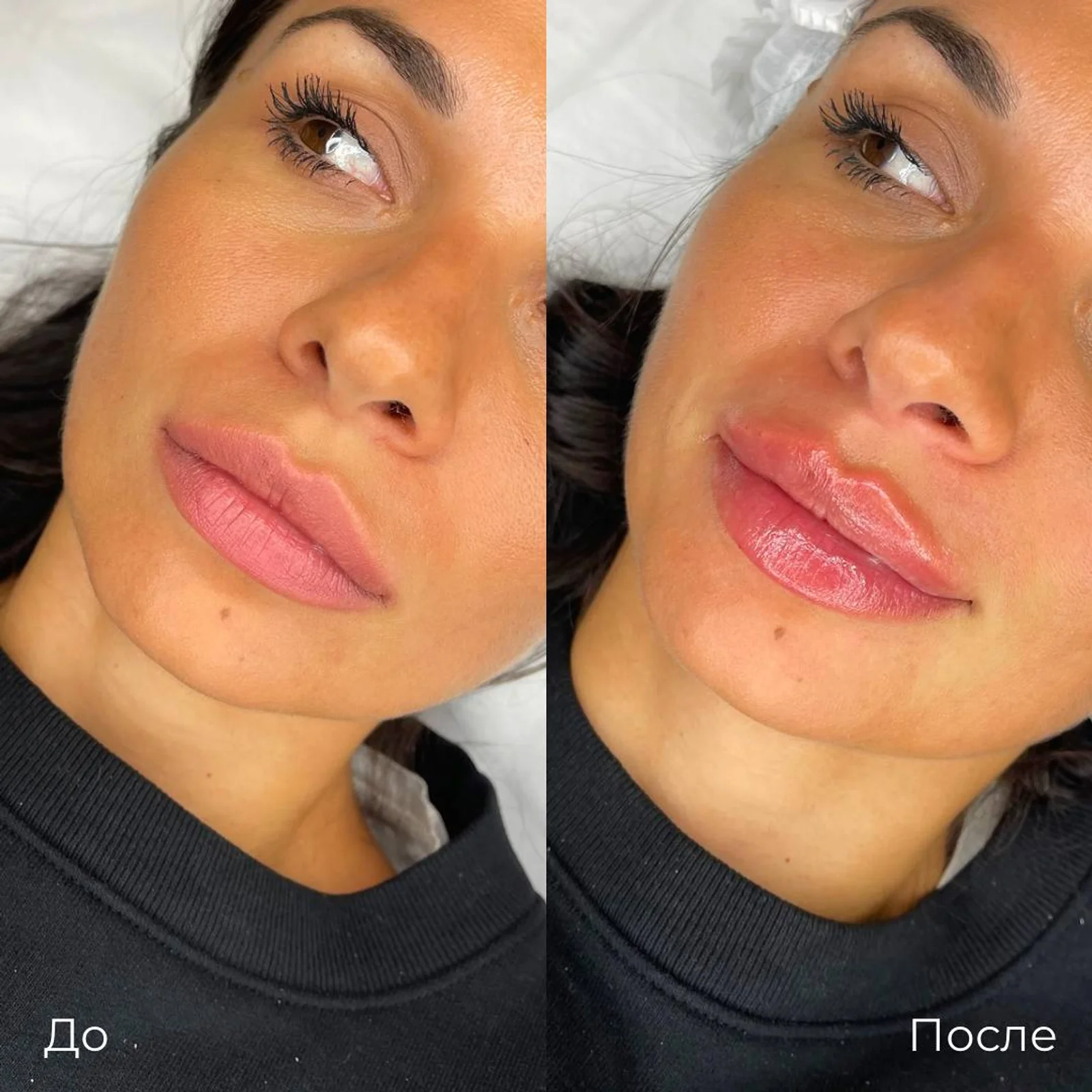 Увеличение и коррекция губ: фотография 15.