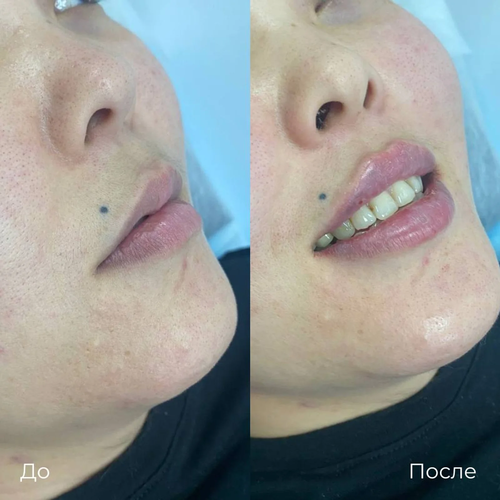 Увеличение и коррекция губ: фотография 23.