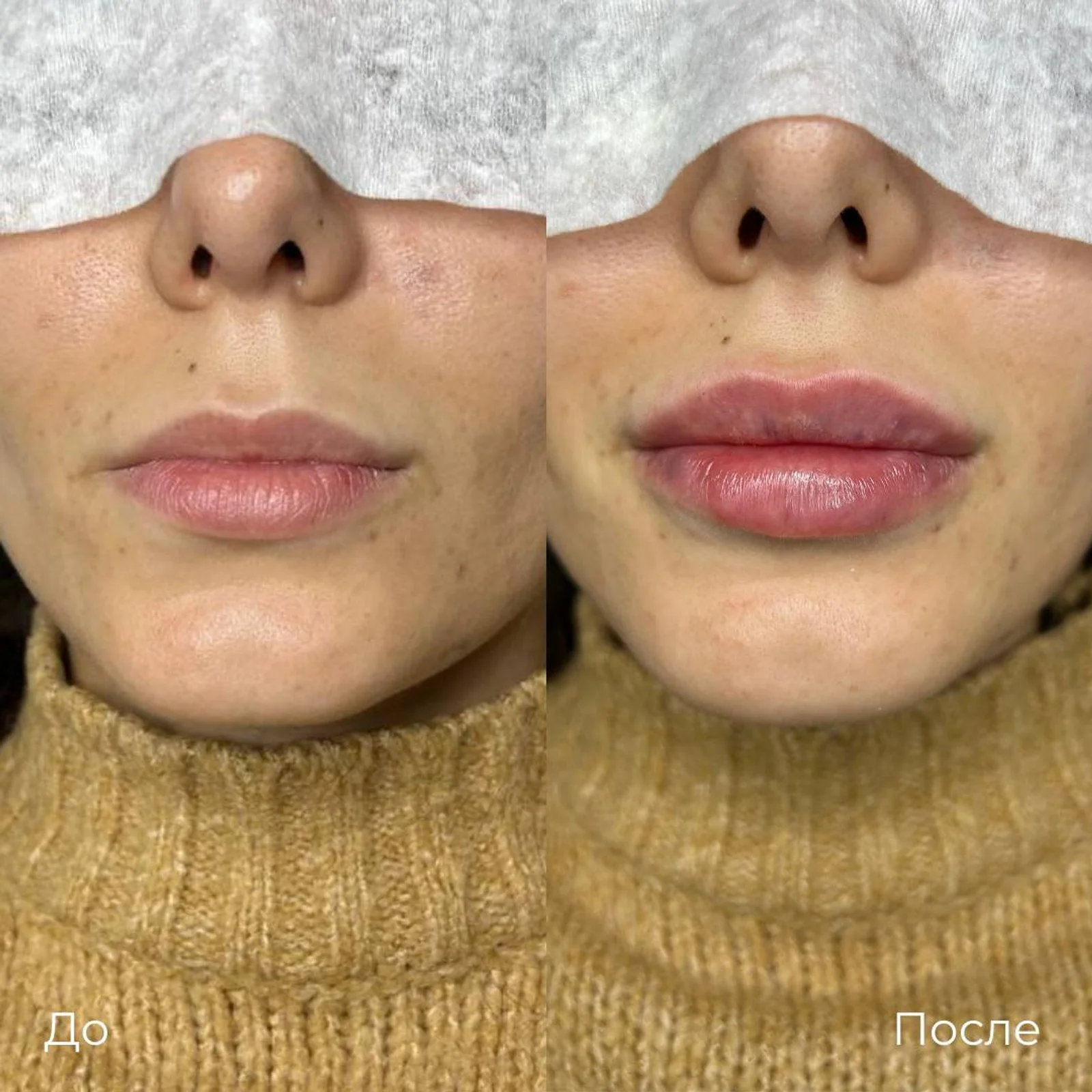 Увеличение и коррекция губ: фотография 24.