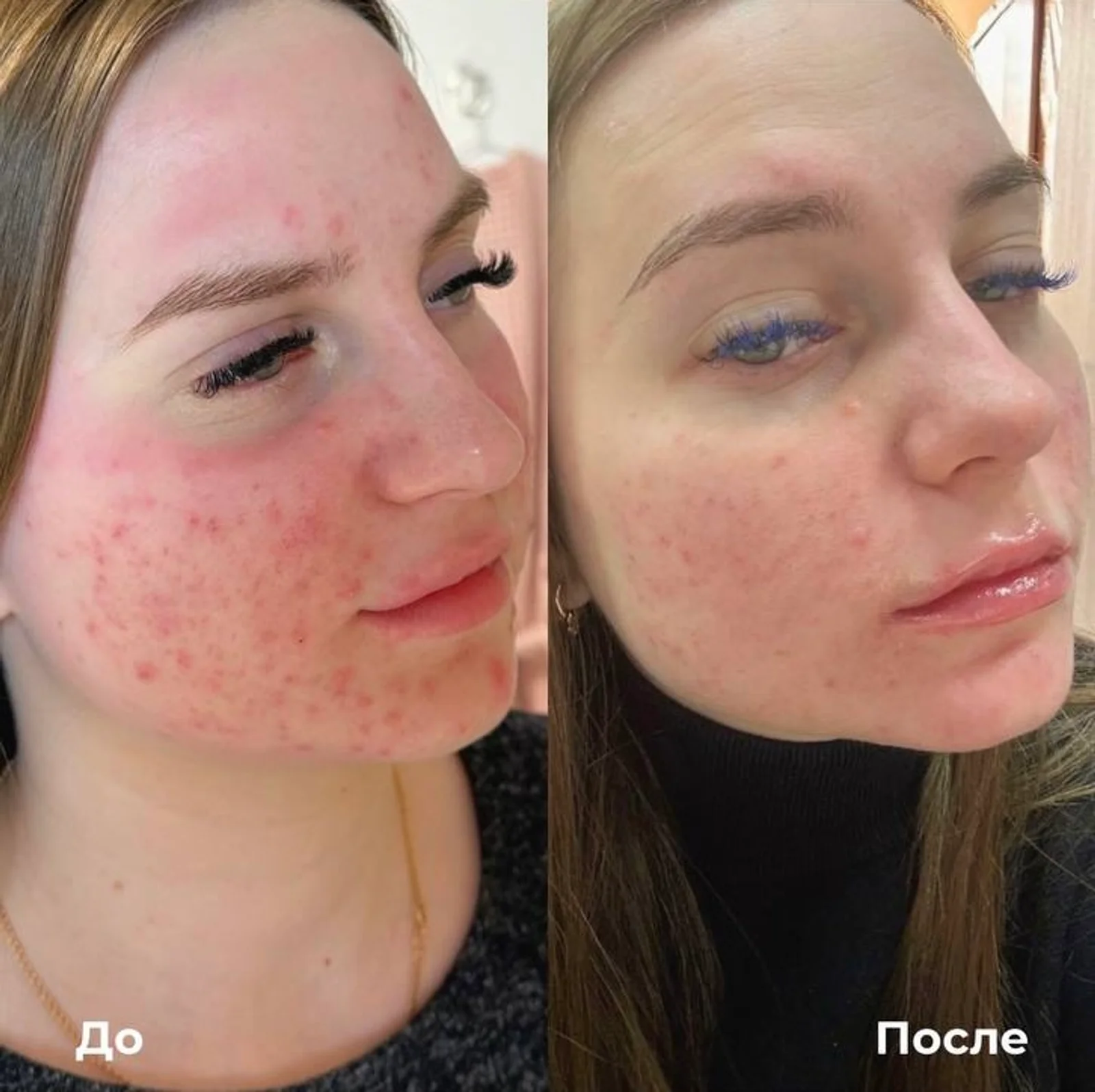 Лазерное лечение акне: фотография 4.