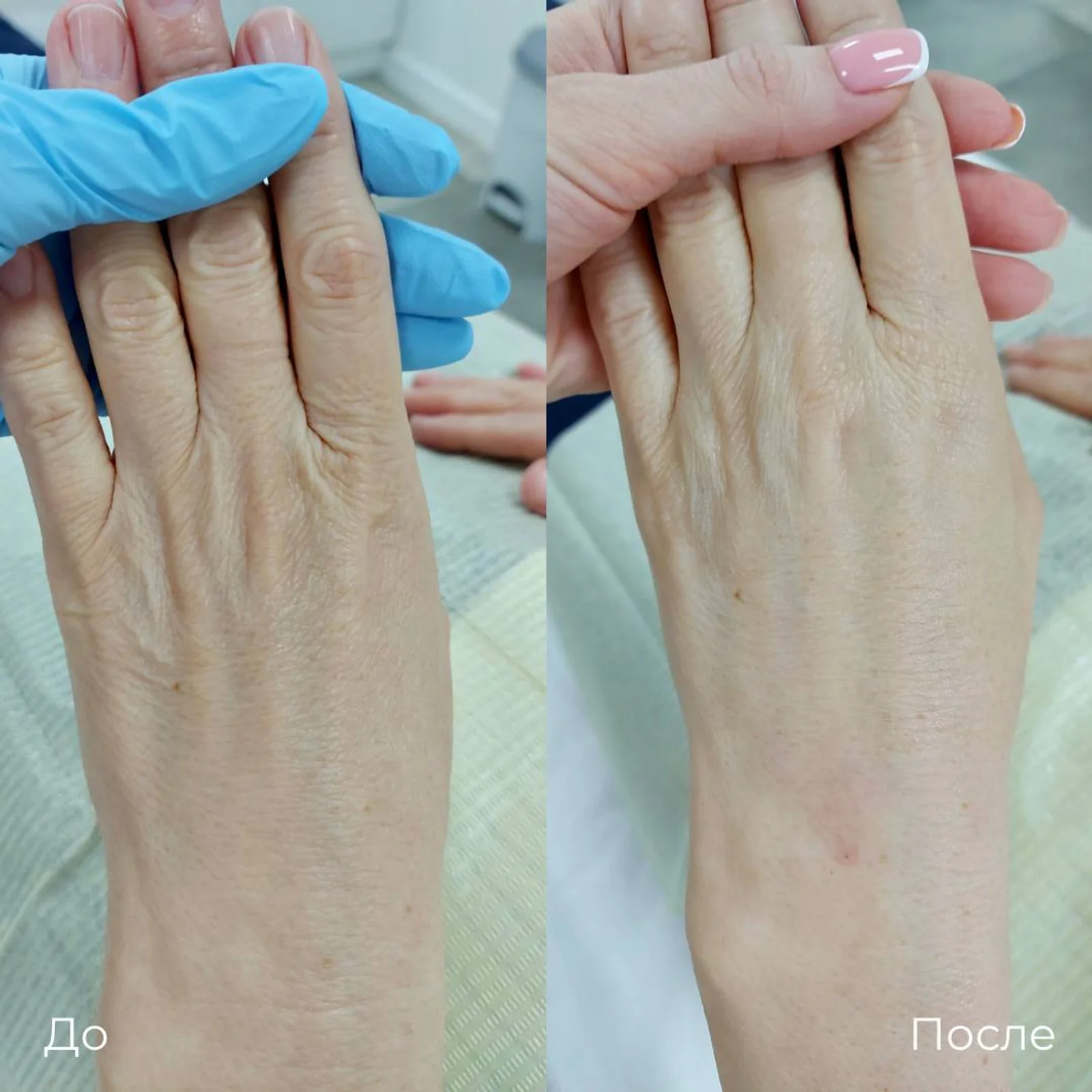 Омоложение кожи рук. Тыльная сторона кисти: слева «До», справа «После». Кисть поддерживает рука в голубой перчатке; на правом снимке поверхность выглядит более ровной.