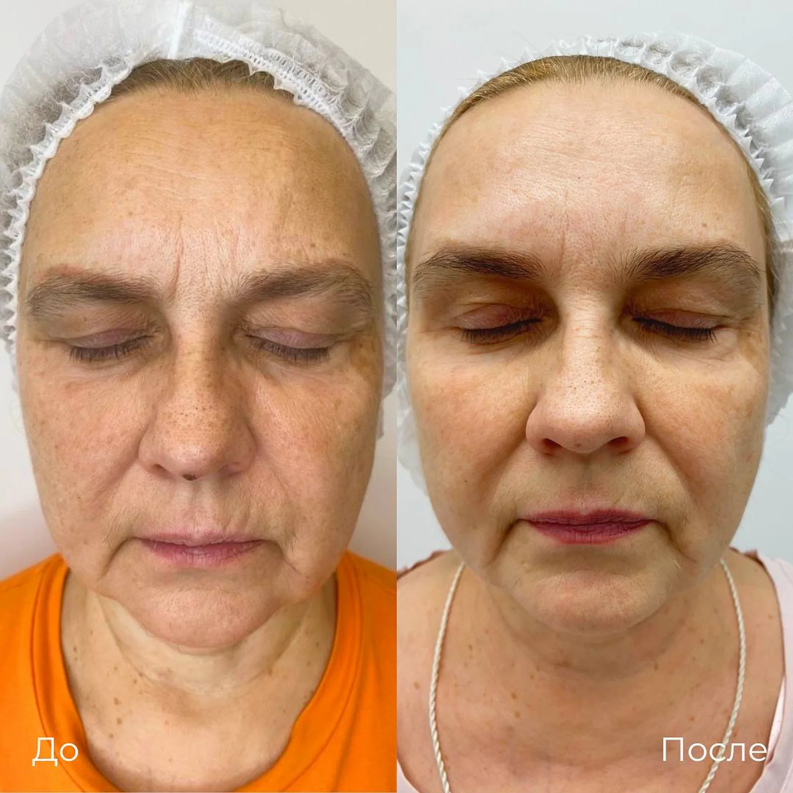SMAS лифтинг лица Ultraformer: фотография 13.