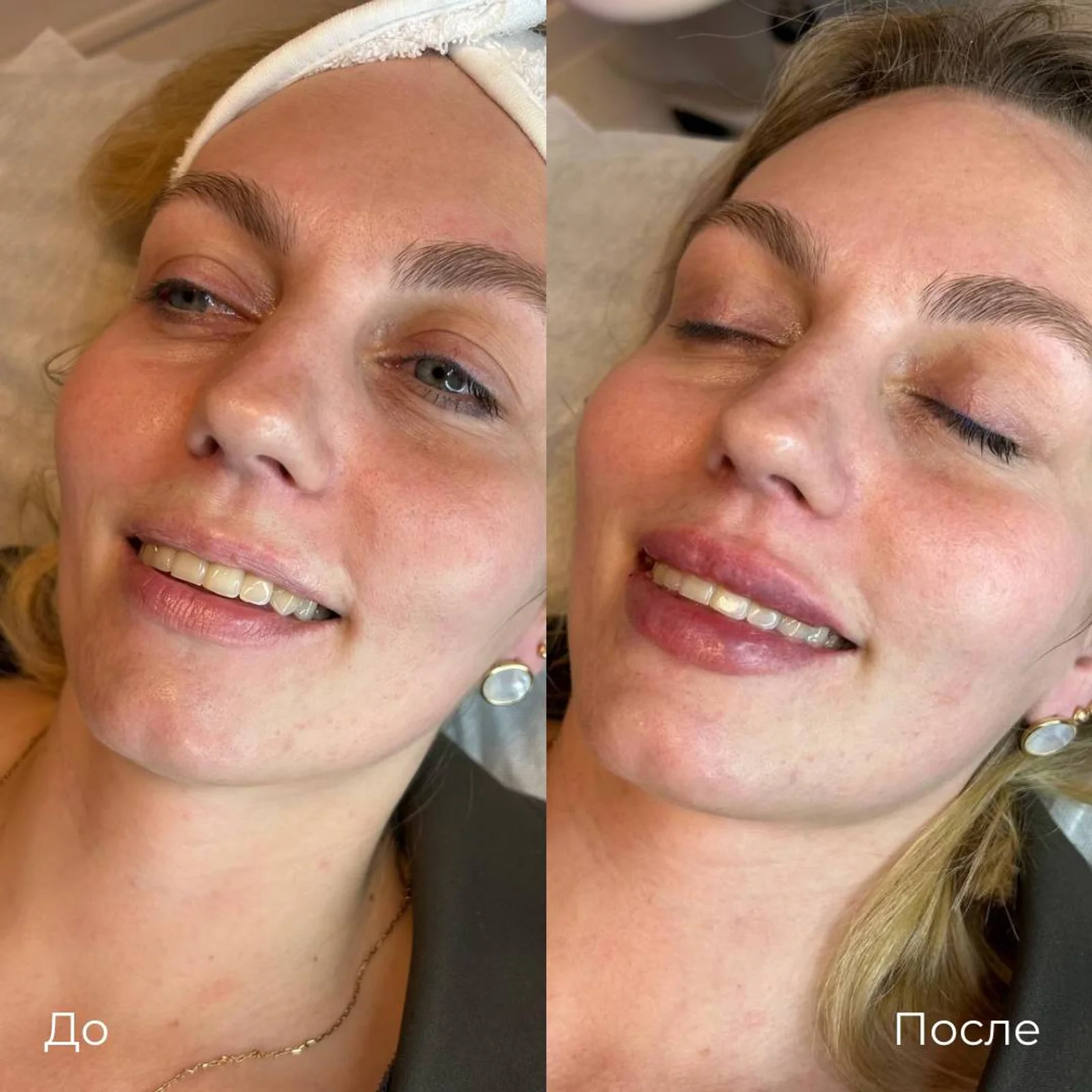 Увеличение и коррекция губ: фотография 22.