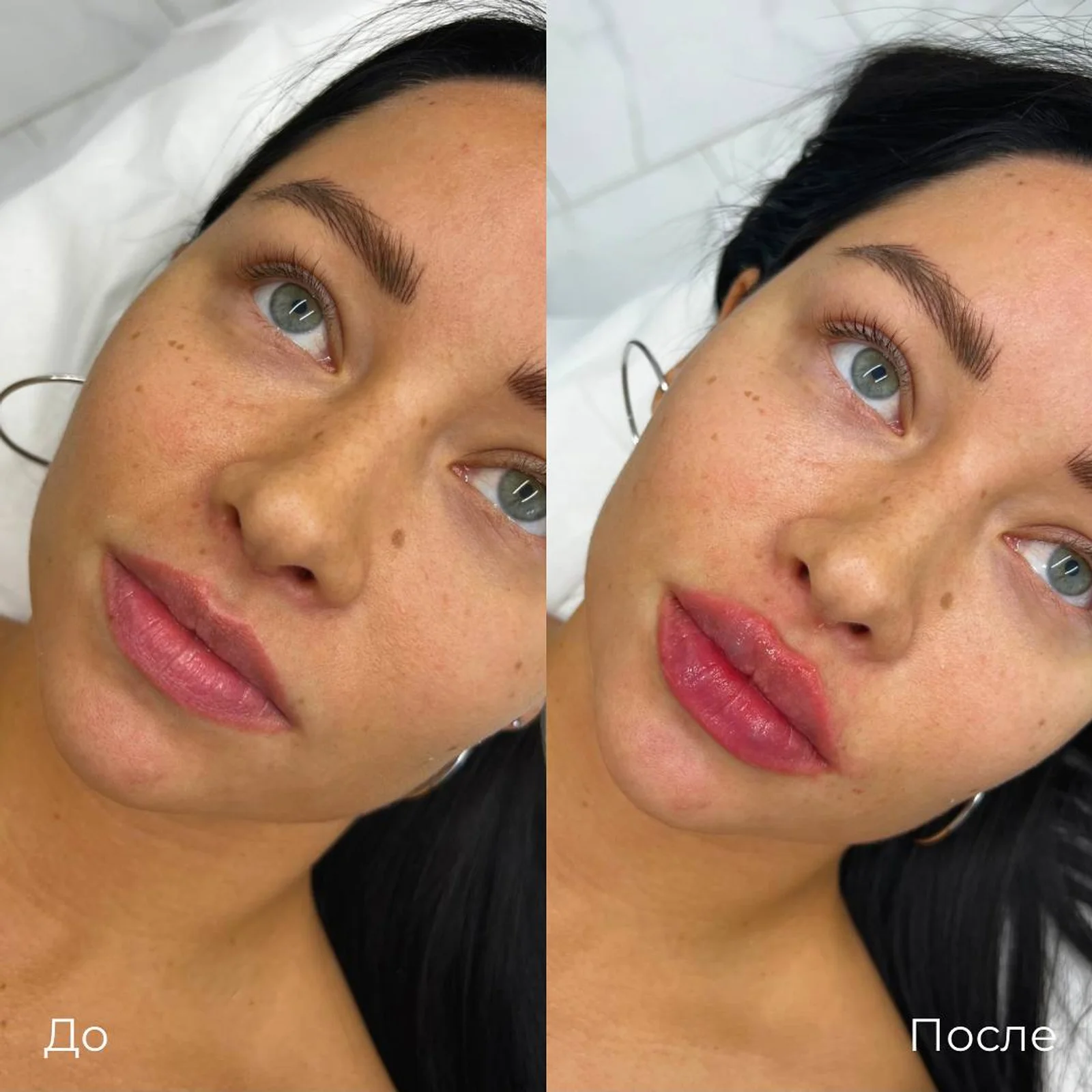 Увеличение и коррекция губ: фотография 14.