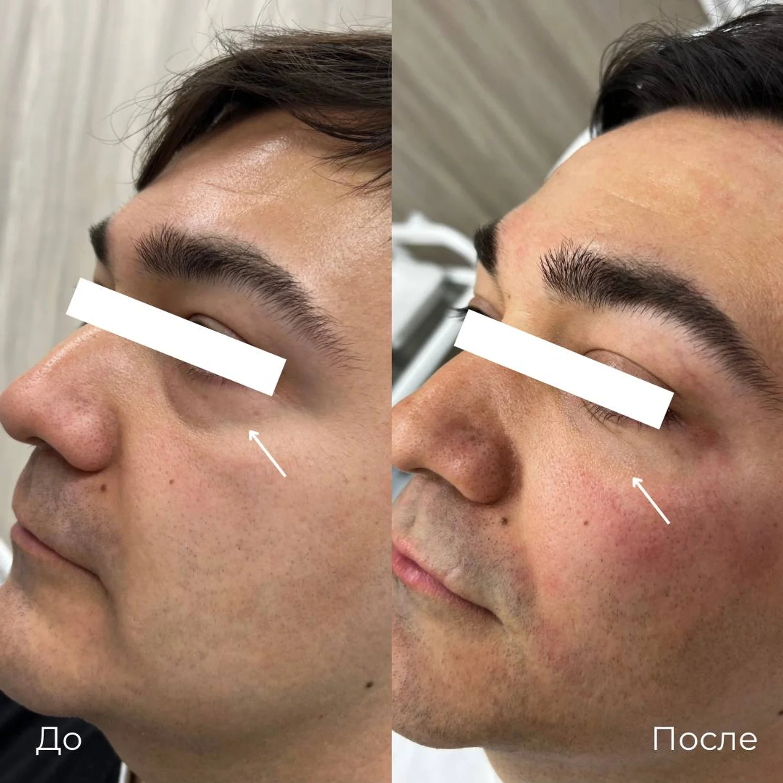 Коррекция темных кругов под глазами: фотография 7.