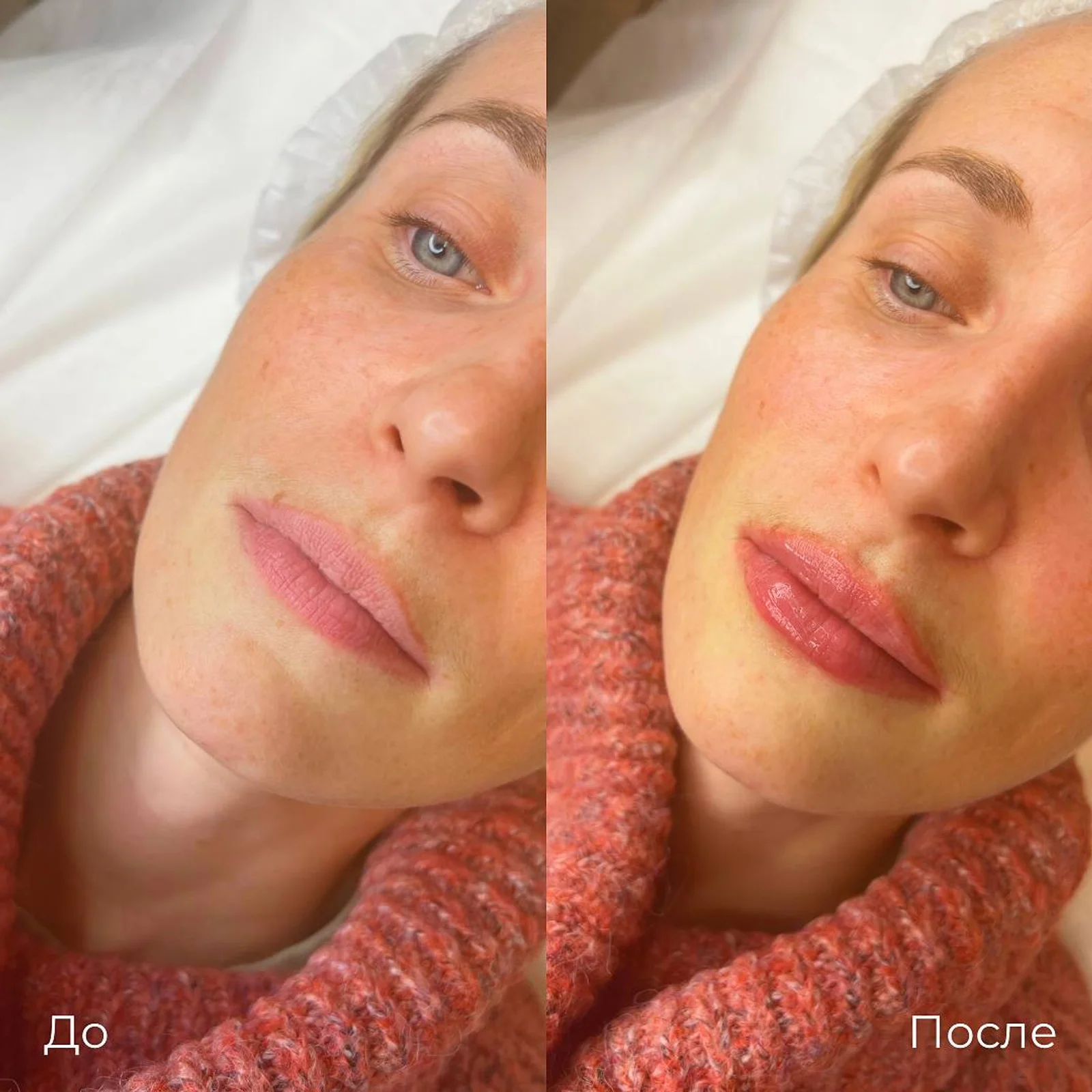 Увеличение и коррекция губ: фотография 34.