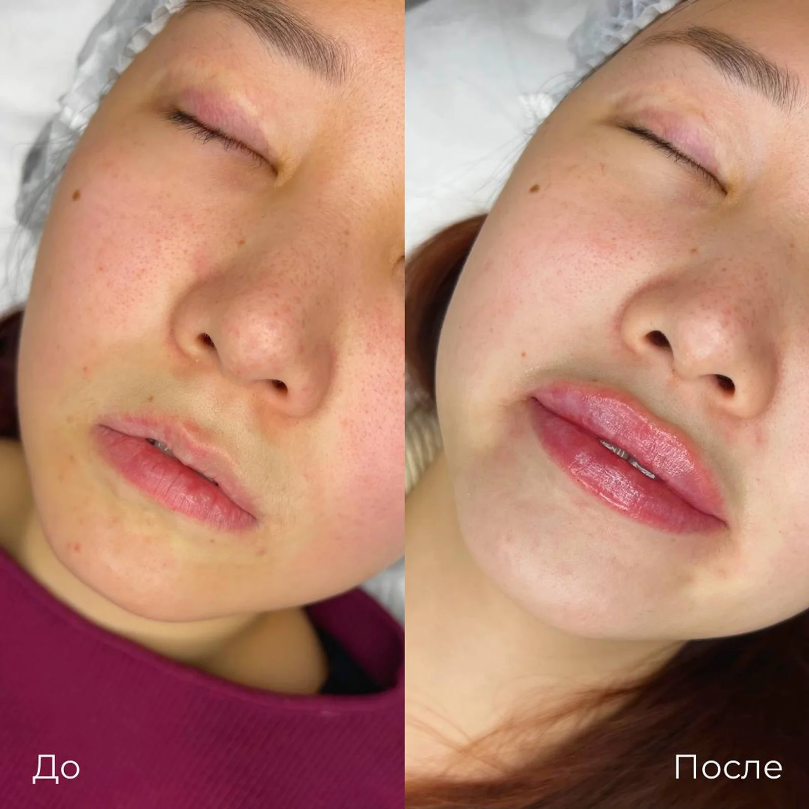 Увеличение и коррекция губ: фотография 13.