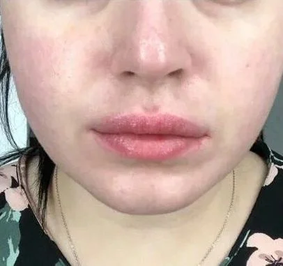 После процедуры