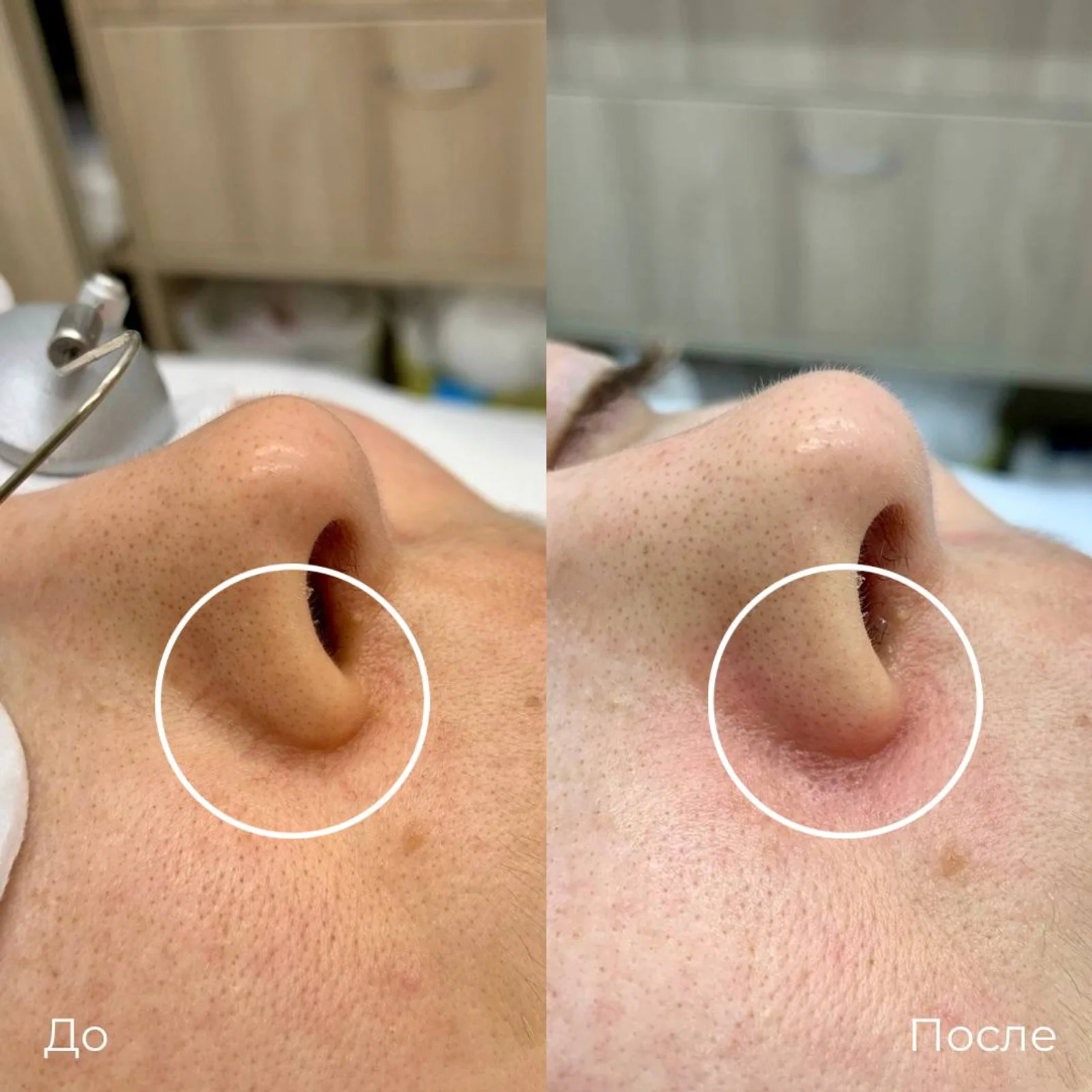 Фототерапия купероза: фотография 11.