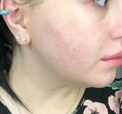 После процедуры