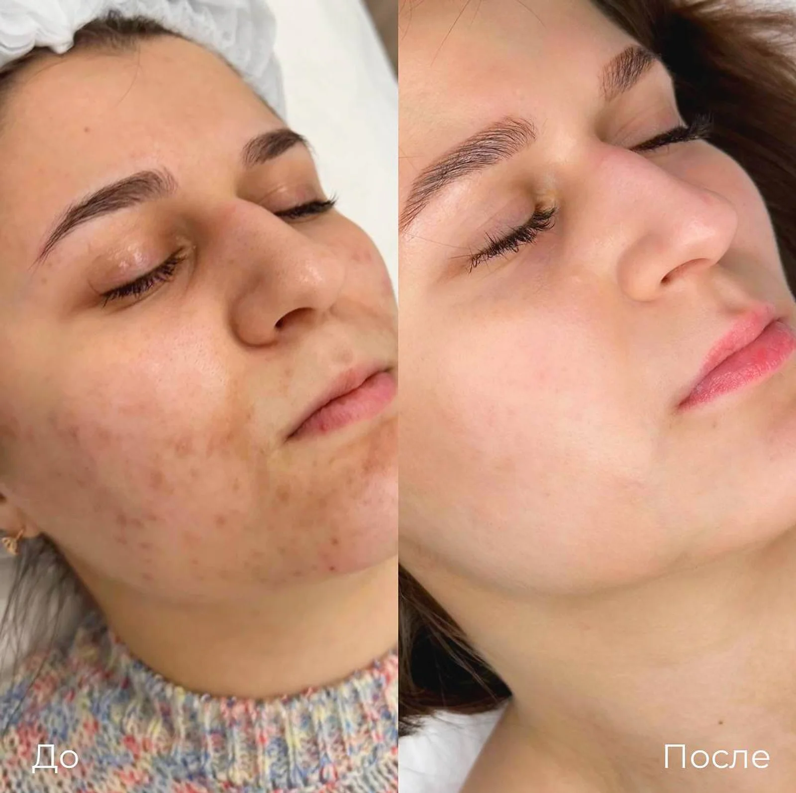Увеличение и коррекция губ: фотография 25.