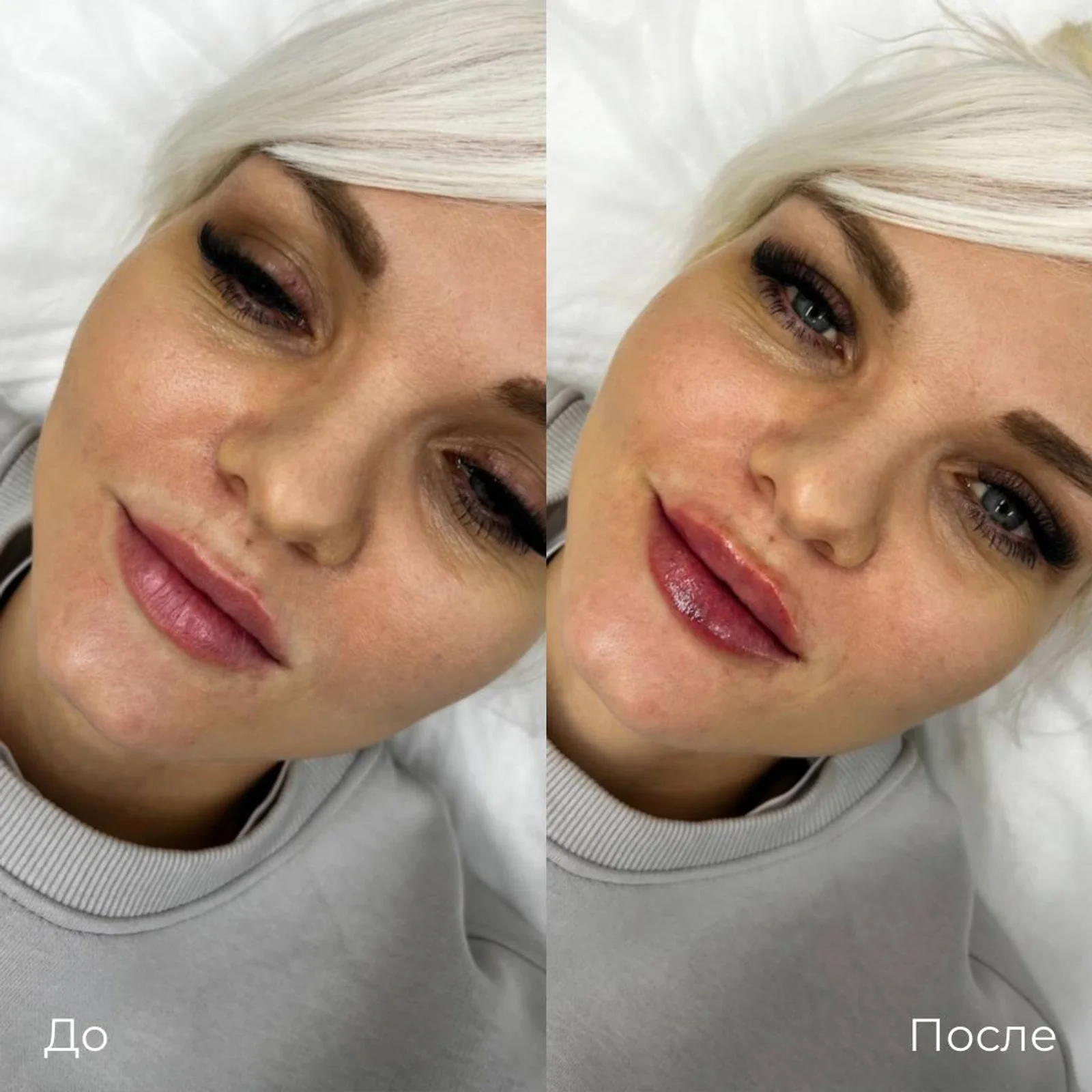 Увеличение и коррекция губ: фотография 18.