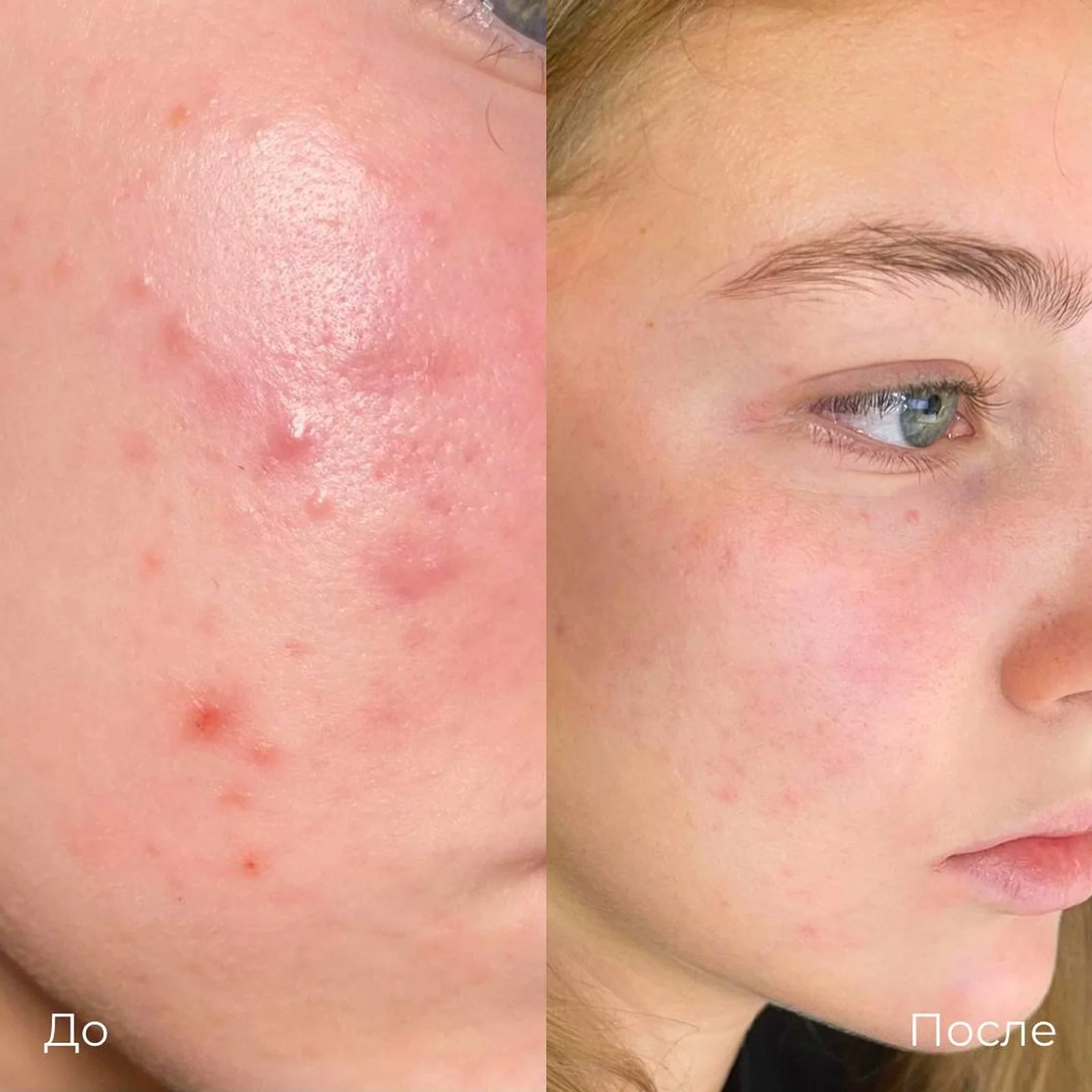 Лазерное лечение акне: фотография 10.