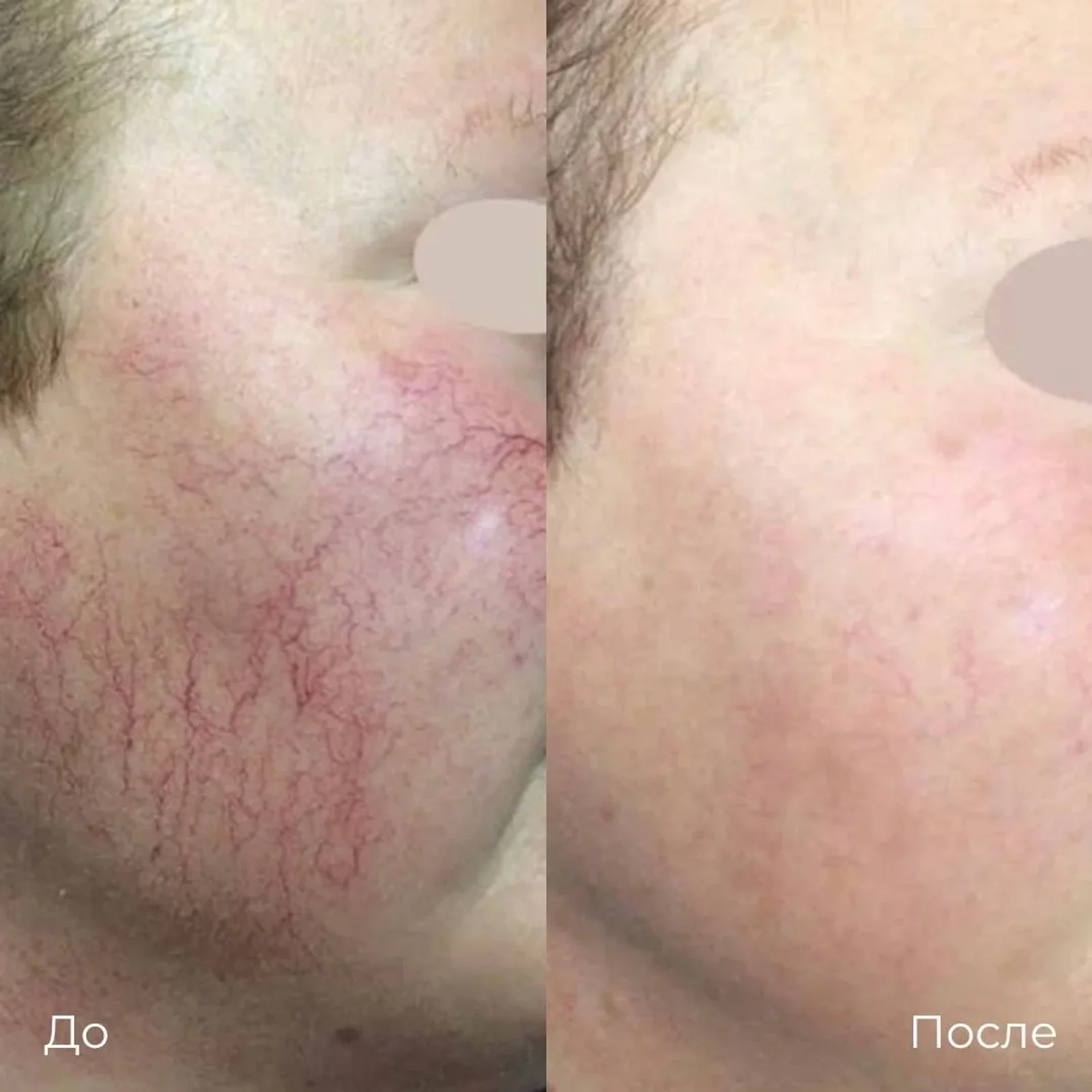 Фотоомоложение. Крупный план щеки у носа; слева «До» с заметной сеткой красных линий, справа «После», где эти линии менее заметны.