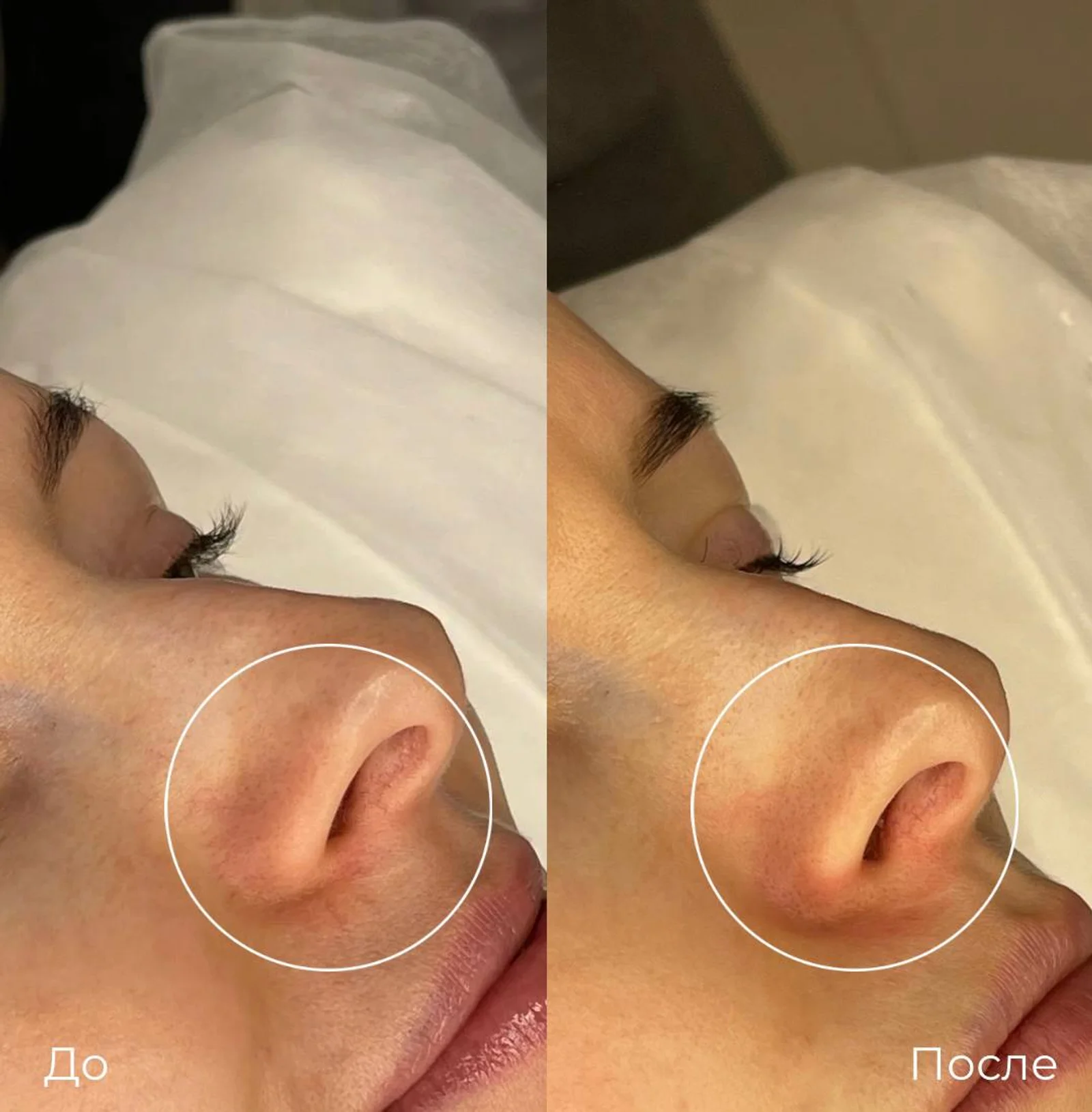Фототерапия купероза: фотография 13.