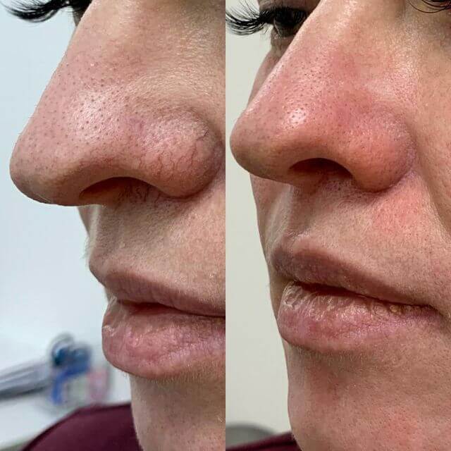 Фото до и после процедуры - Удаление сосудов на лице