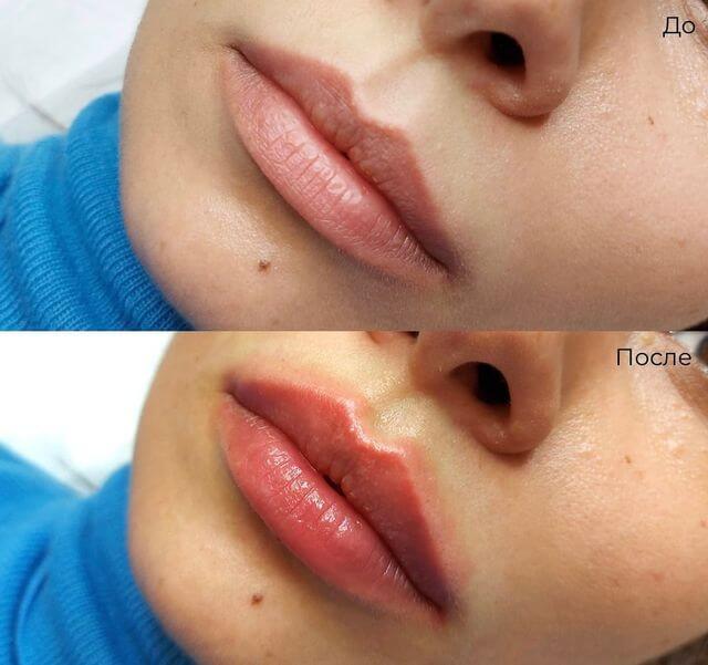Фото до и после процедуры - Увеличение губ