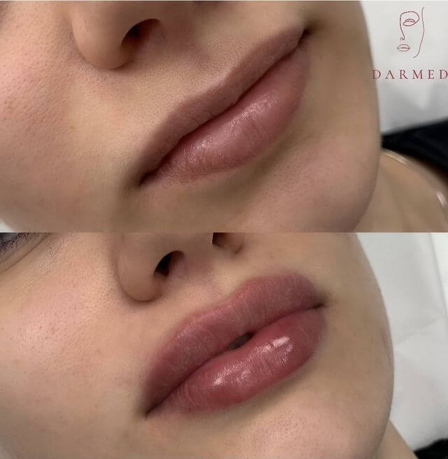 Фото до и после процедуры - Увеличение губ