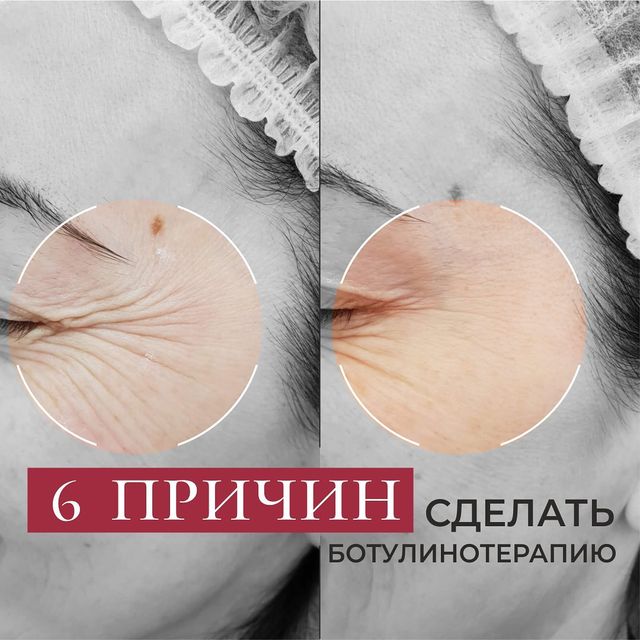 Фото до и после процедуры - Коррекция мимических морщин