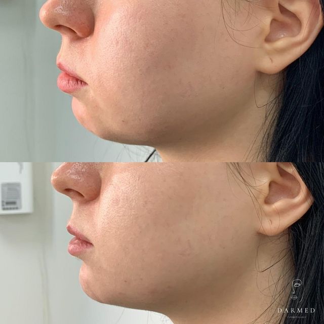 Фото до и после процедуры - Нижняя треть лица