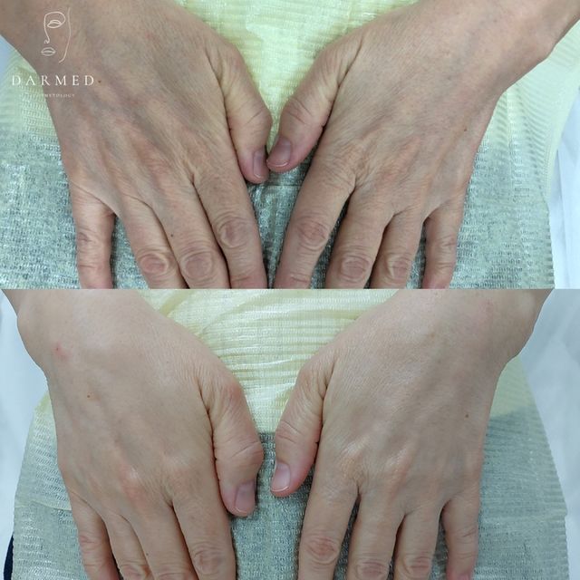 Фото до и после процедуры - Контурная пластика рук