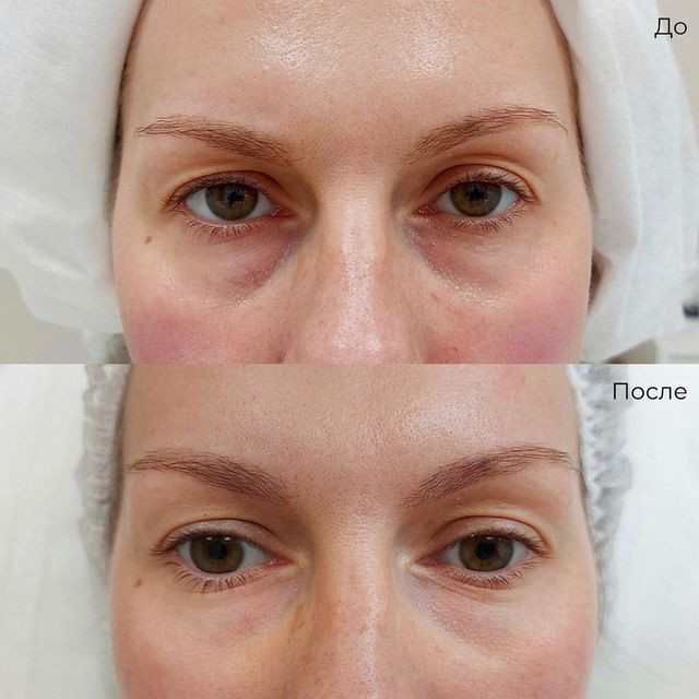 Фото до и после процедуры - Коррекция темных кругов под глазами
