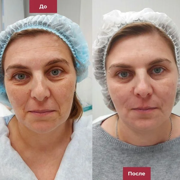 Фото до и после процедуры - full face