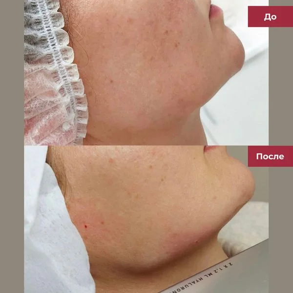 Фото до и после процедуры - контурная пластика углов нижней челюсти