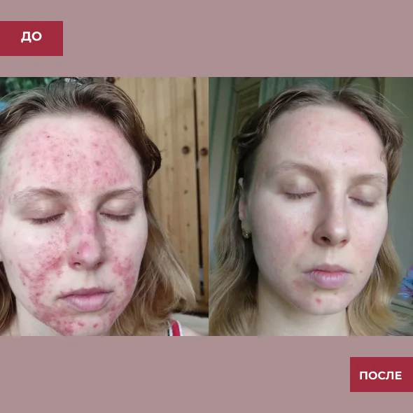Фото дерматологической чистки лица до и после