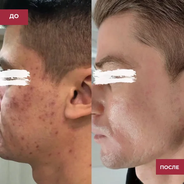 Фото дерматологической чистки лица до и после