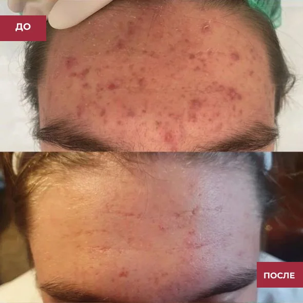Фото лазерного лечения акне до и после