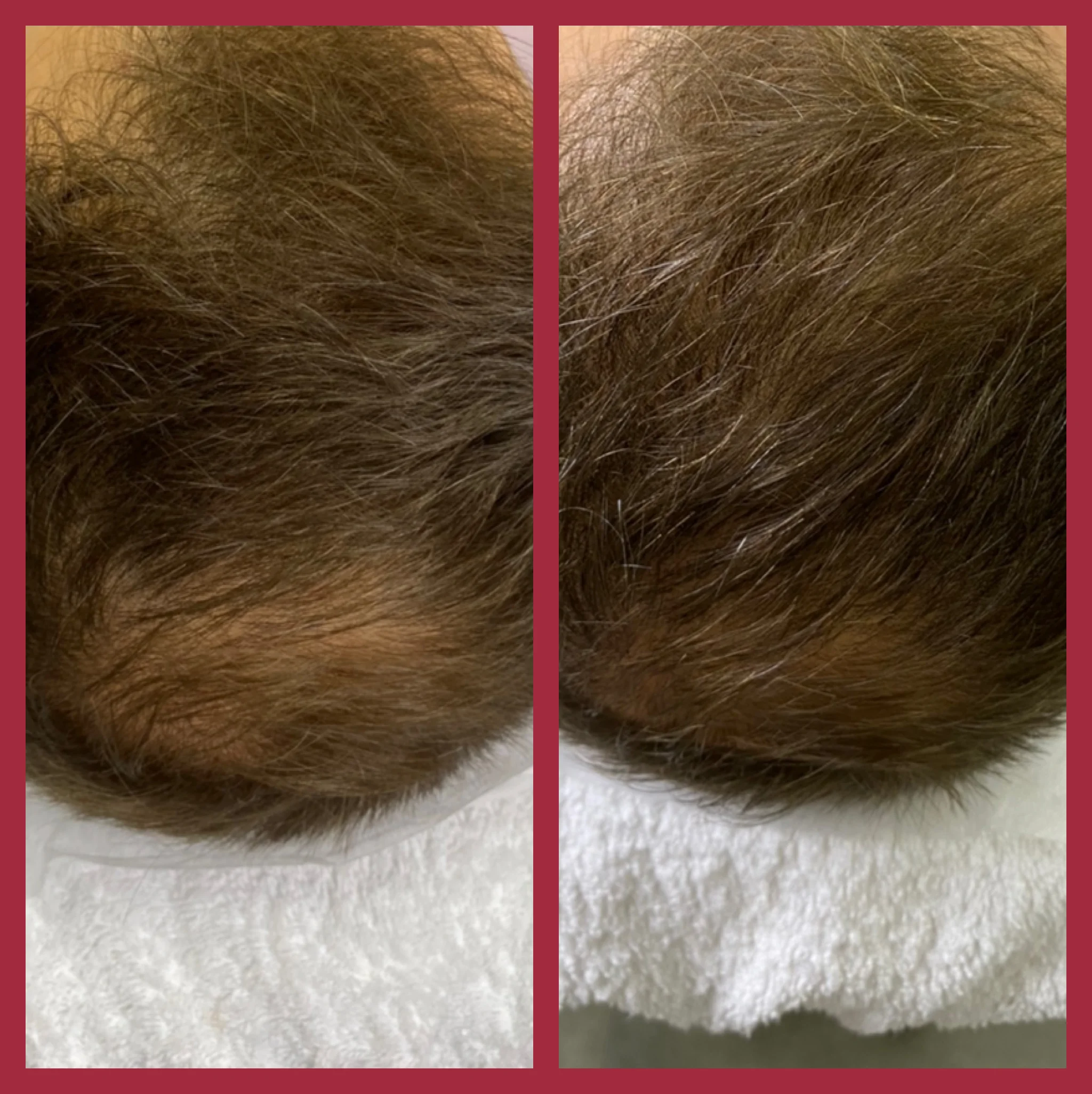 Фото: до и после процедуры лечения выпадения волос