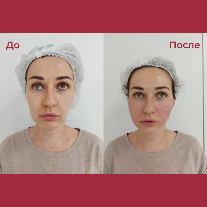 Фото: до и после процедуры лечения выпадения волос