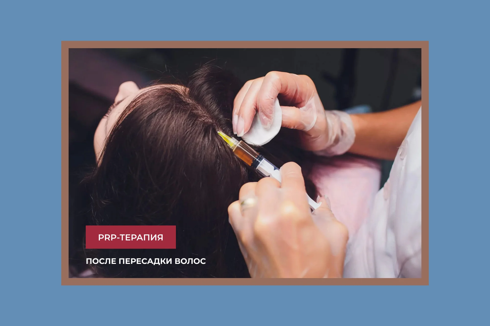 Постер для статьи: PRP-терапия после пересадки волос