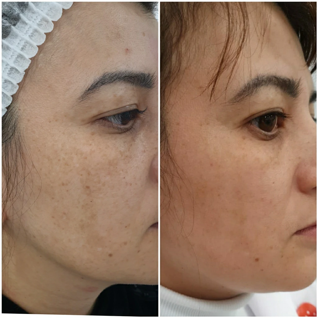Фото: до и после процедуры лечения выпадения волос